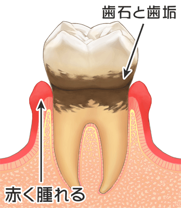 歯肉炎の治療
