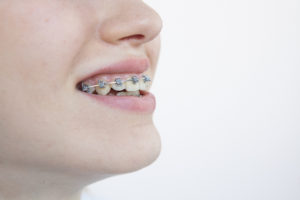 矯正歯科治療中の歯