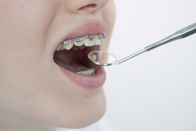 矯正歯科治療中の歯