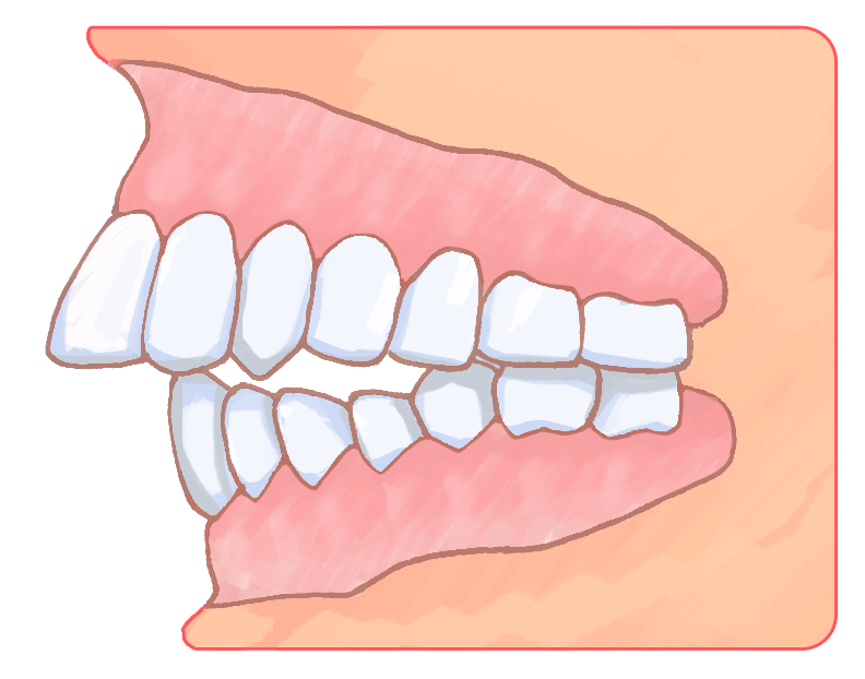 矯正歯科治療で抜歯が必要な歯並び